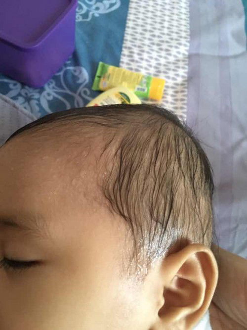 Keringat berlebih pada bayi