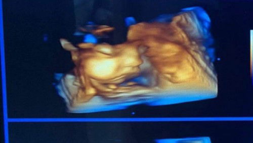 เบาหวานขณะตั้งครรภ์