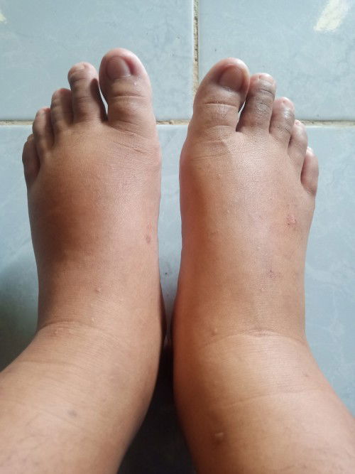 Kaki bengkak apakah baik2 saja? 🥺