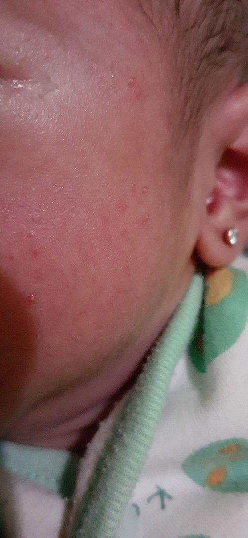 Bintik2 di pipi bayi