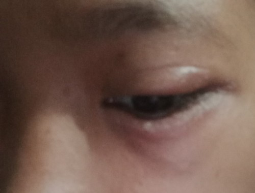 Maaf bucan mau tanya kalo bengkak kaya gini obat nya apaa ya ...