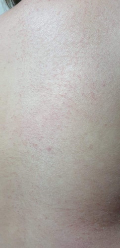 Rashes, is it normal?