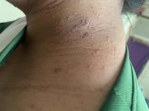 pregnancy rashes