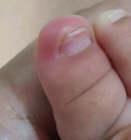 Baby ingrown toenail?