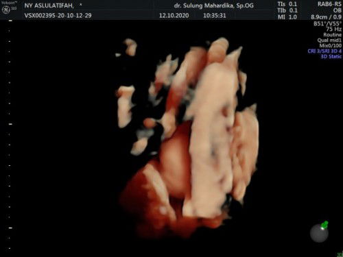 Akurat tidak nya Usg 4D😍