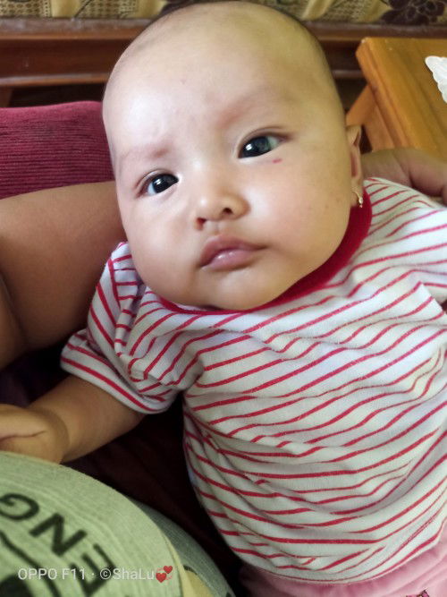 tanda strawberi/hemangioma