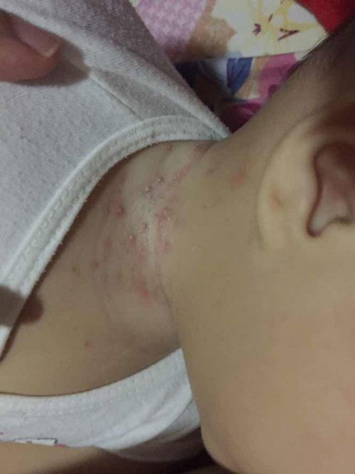 Rashes sa liig ni lo