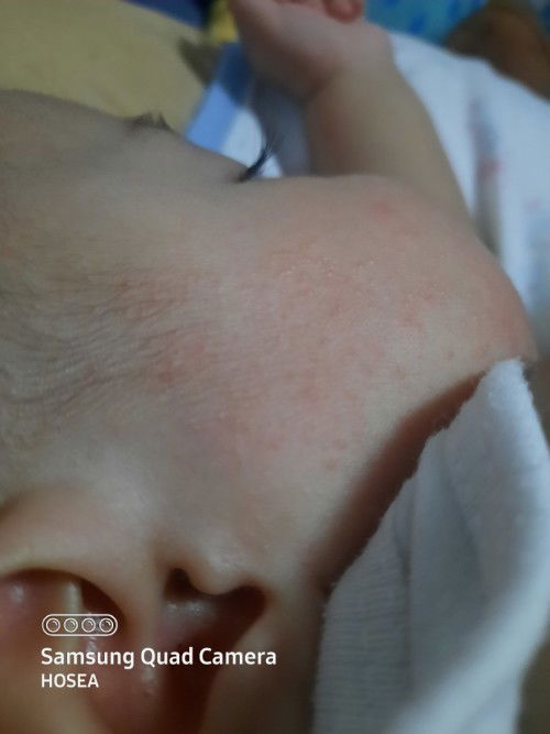 Is this tigdas hangin or rashes?