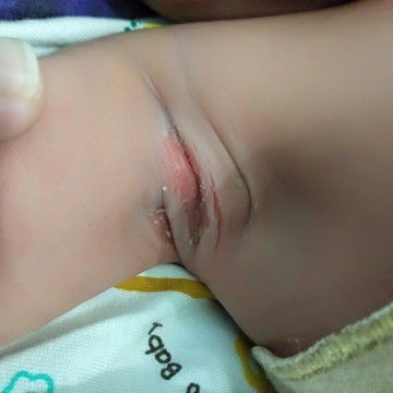 Kulit lipatan lecet & berbau