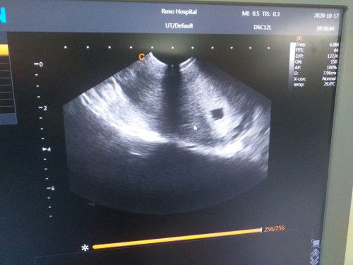 จากเมื่อเช้าที่มีเลือดออกนิดหน่อยไปหาหมอมาแล้วภาพซาวแบบนี้ถือว่ายังปกติอยู่ใช่มั้ยคะ