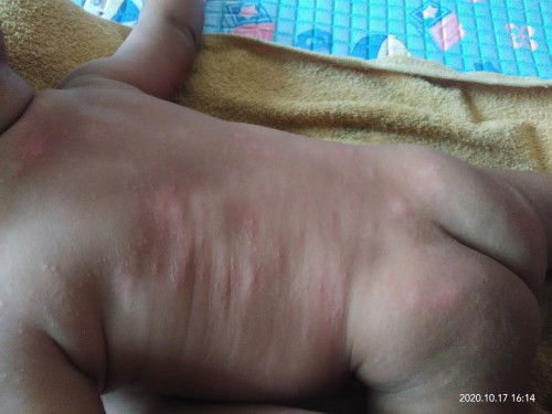 Bintik merah pada kulit bayi