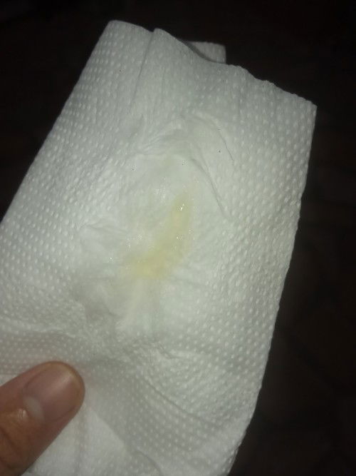 มูกใสหรือตกขาว