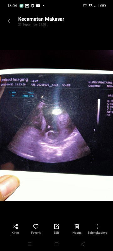 Hasil USG 13minggu