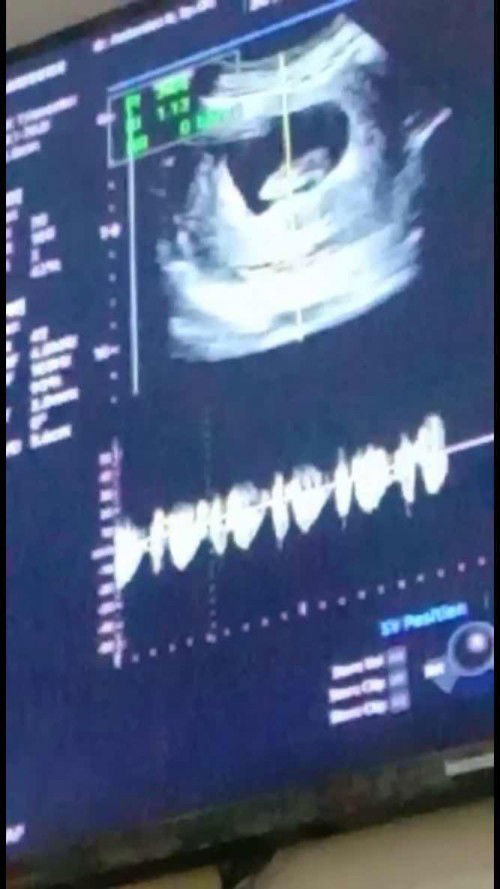 Usg Kedua kehamilanku