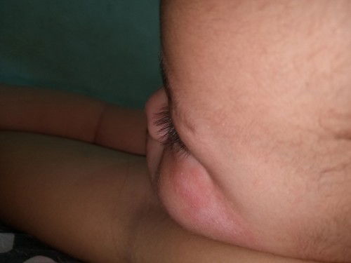 Ruam parah di pipi tampa sebab