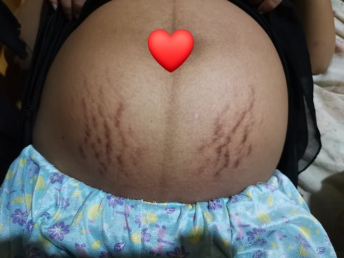 Stretch marks ๐ญ