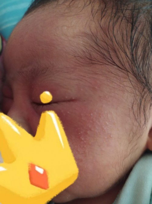 Ruam/ Biang keringat