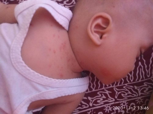 benjolan dibelakang telinga