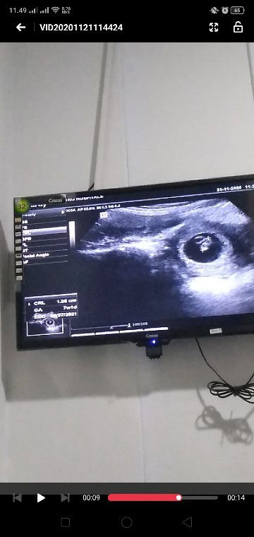 Habis USG , UK beda seminggu