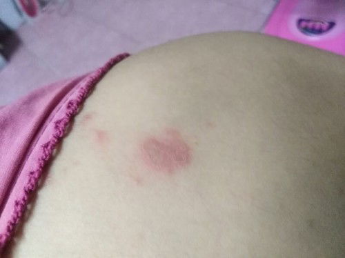 มีตุ่มขึ้นแบบนี้ข้างหัวไหล่​ แม่ๆๆบ้านไหนเคยเป็นบ้างมั้ยคะ.. เป็นอันตรายมั้ย #ลักษณะคล้ายเริม