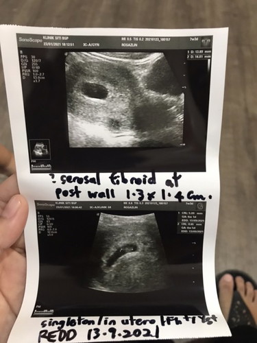 Pregnant with Fibroid