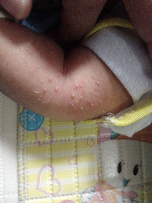 Masalah kulit baby