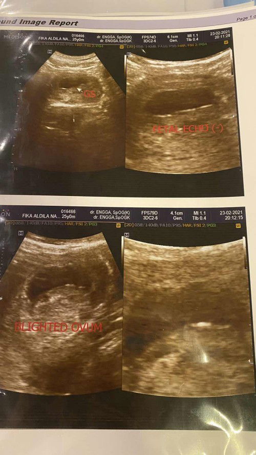 Dinyatakan blighted ovum