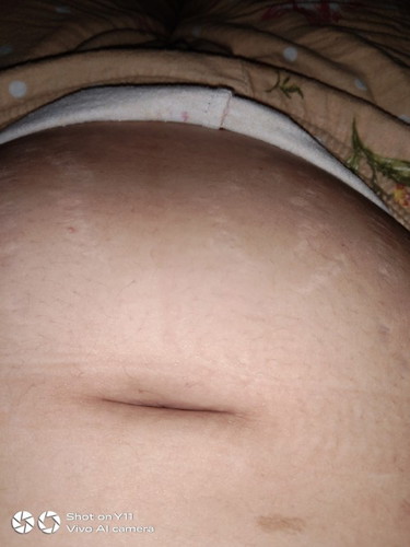 Small bump