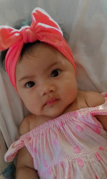 Late Milestone and Hair Loss