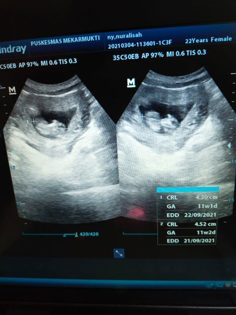 Usia kandungan usg.