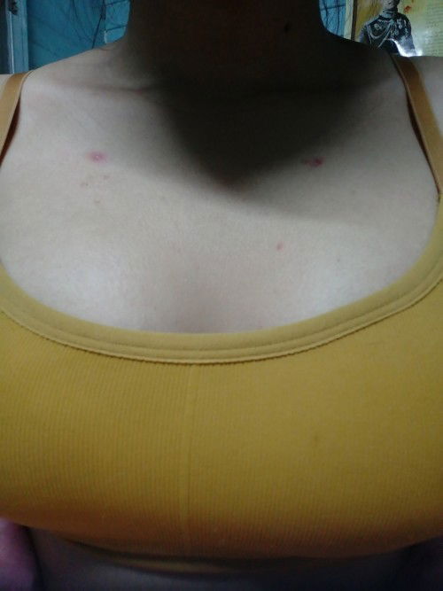 ตั้งแต่ท้องเราก็เริ่มมีเม็ดแดงๆขึ้นที่หน้าอกและแผ่นหลัง​ แม่ๆพอรู้วิธีรักษามั้ยงับ​