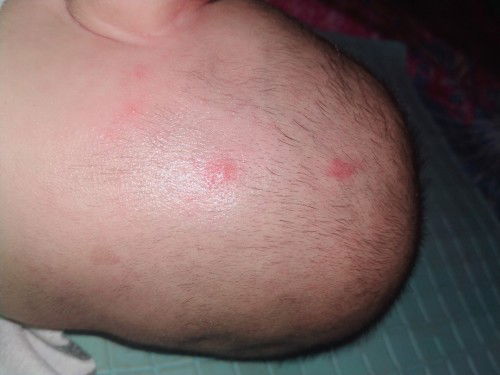 Bentol merah pada bayi usia 4 bulan