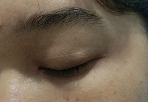 Benjolan di mata di trimester akhir kehamilan