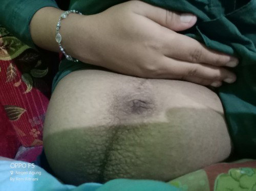 Gatal di bagian perut