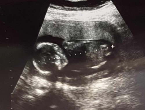 Guess the baby gender?