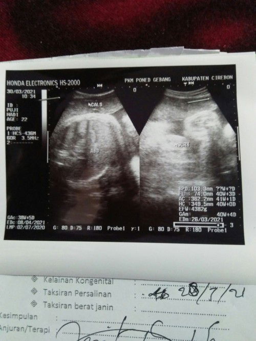 Ukuran fundus 27cm apa bener berat baby mencapai 4kg  dan  ini hasil USG ny bener apa gk ya?