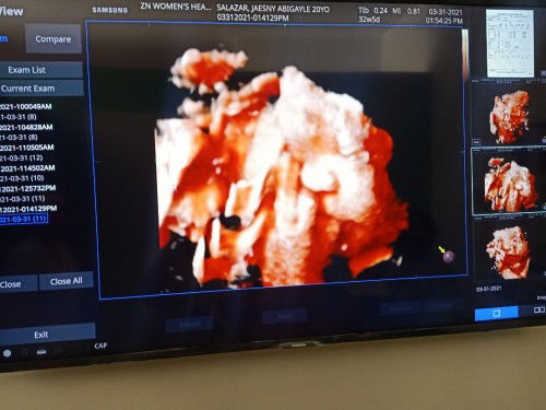 3D ULTRASOUND OF OUR BABY GIRL