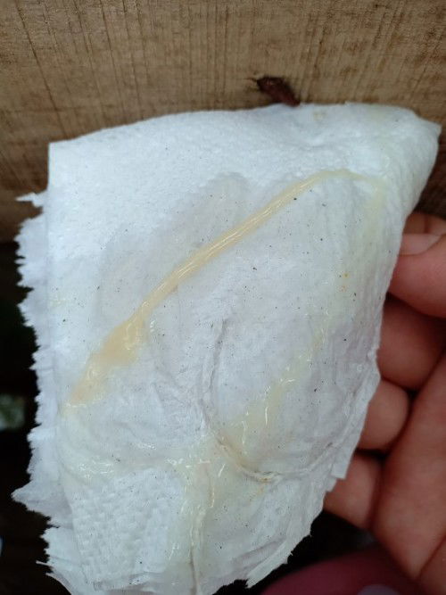 Nay e bị ra như này có phải bung nút nhầy không ạ