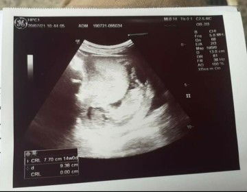 สอบถามค่ะท้องแรก