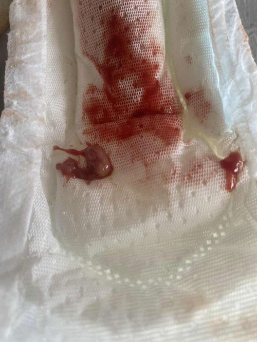 แชร์ประสบกราณ์ หลังแท้งไม่ครบ ขูดมดลูก