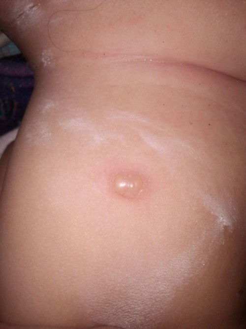 น้องเป็นตุ่มน้ำ