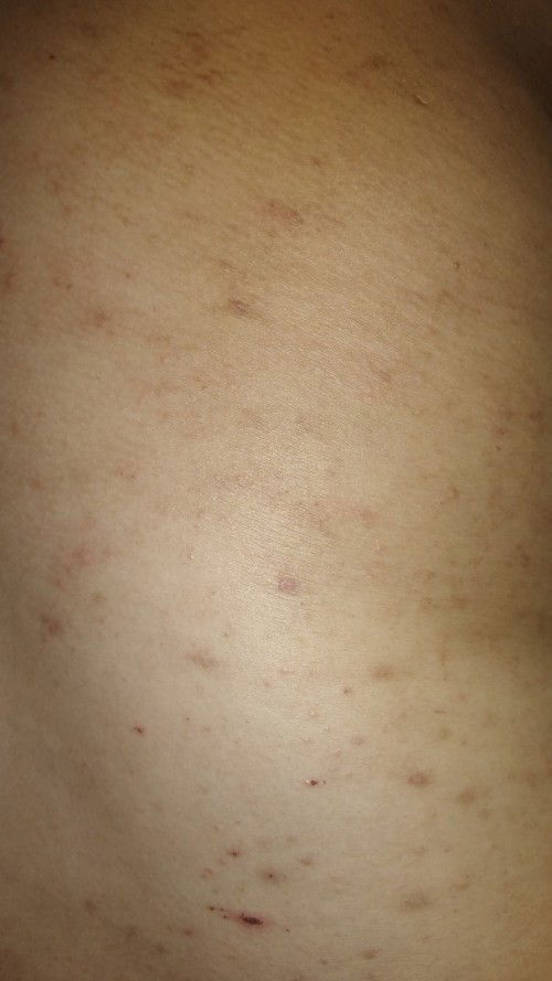 Gatal di seluruh badan saat hamil