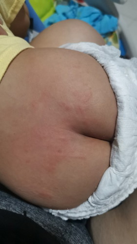Rash? Bug bite?