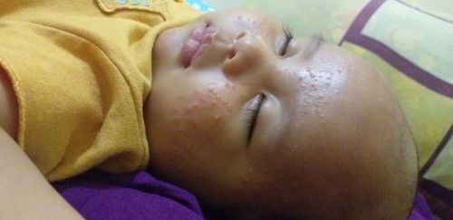 Obat bruntusan pada bayi 2 bln