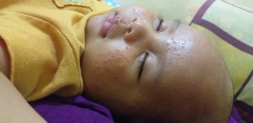 Obat bruntusan pada bayi 2 bln