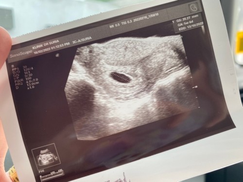 8week pregnant