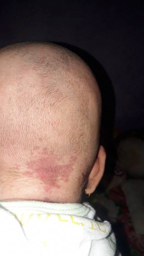 Muncul bercak merah di kepala bayi