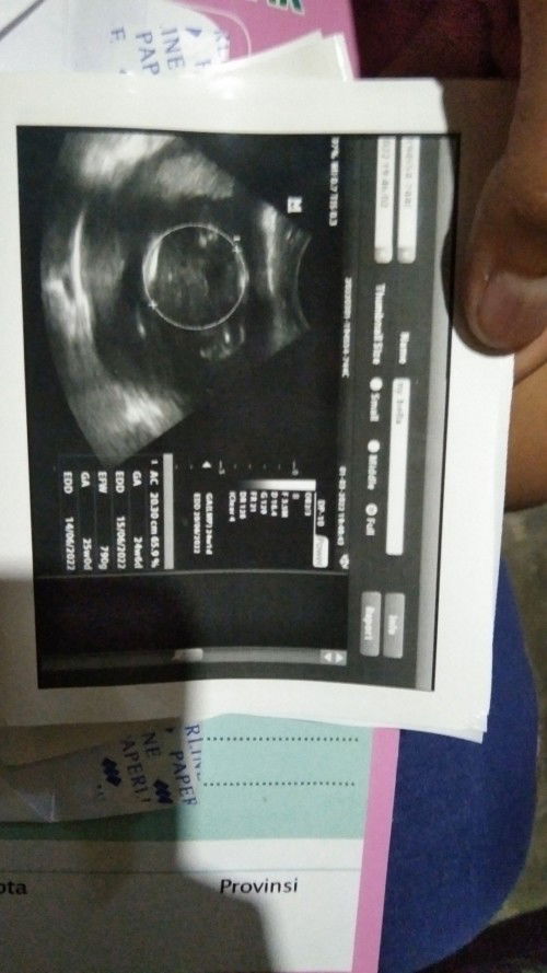 Usg 25week JK bisa berubh atau tidak