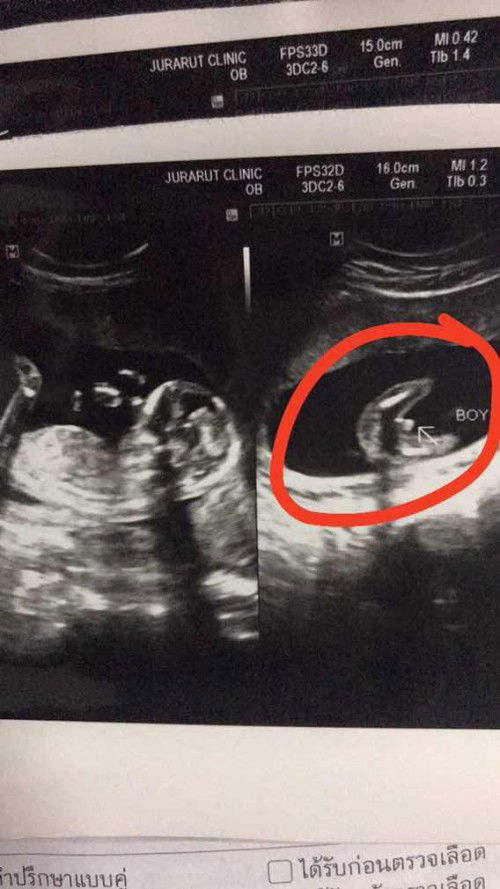 สภาวะซึมเศร้าในหญิงคั้งครรภ์