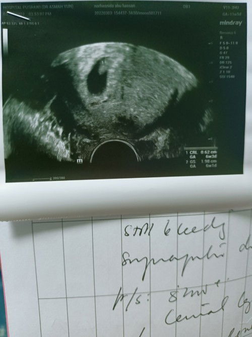 Bleeding & baby belum ade heartbeat lagi ☹️ sharing pengalaman & kata semangat please mommies semua